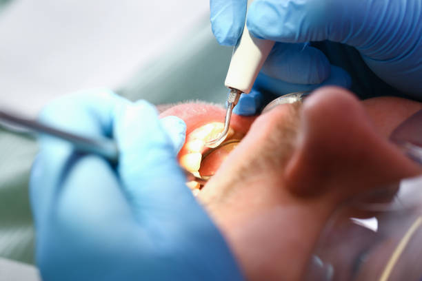Best Emergency Dental Care for Broken or Chipped Teeth in St Charles, IL