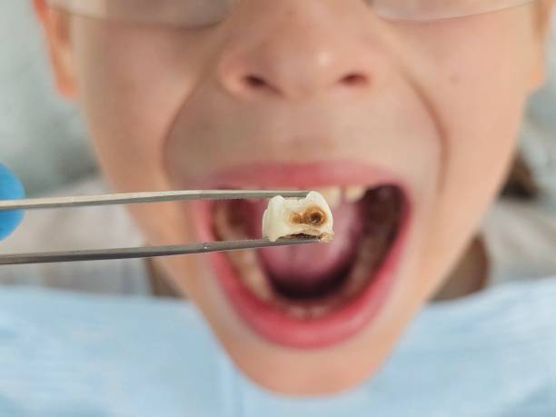 Best Emergency Treatment for Dental Infections or Abscesses in St Charles, IL